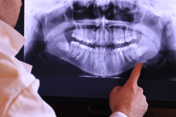 Best Emergency Wisdom Teeth Removal in Choteau, MT